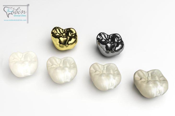روکش های دندان از نظر مواد سازنده با یکدیگر متفاوت هستند